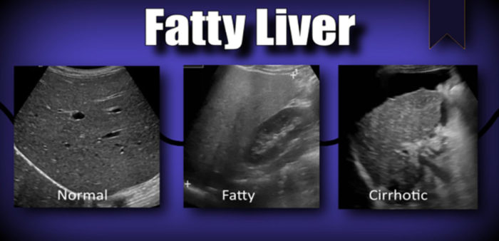 Fibroscan liver Elastography Sky Diagnostics Delhi Uttam Nagar